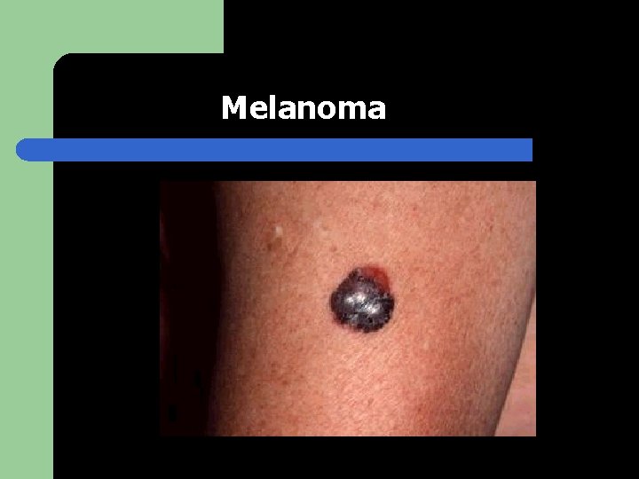 Melanoma 