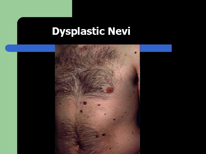 Dysplastic Nevi 