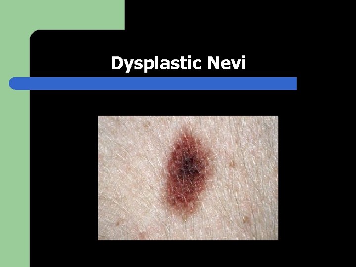 Dysplastic Nevi 