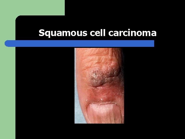 Squamous cell carcinoma 
