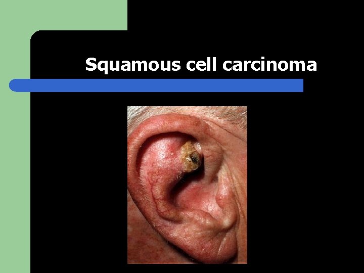 Squamous cell carcinoma 