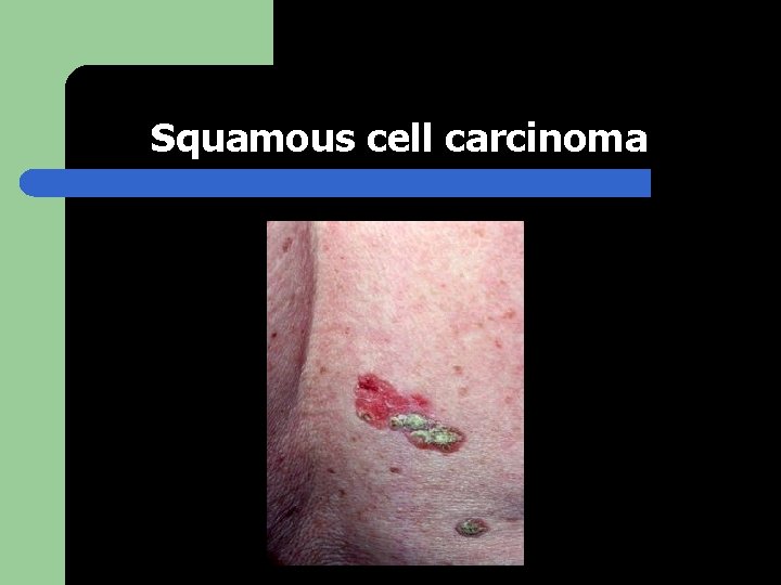 Squamous cell carcinoma 