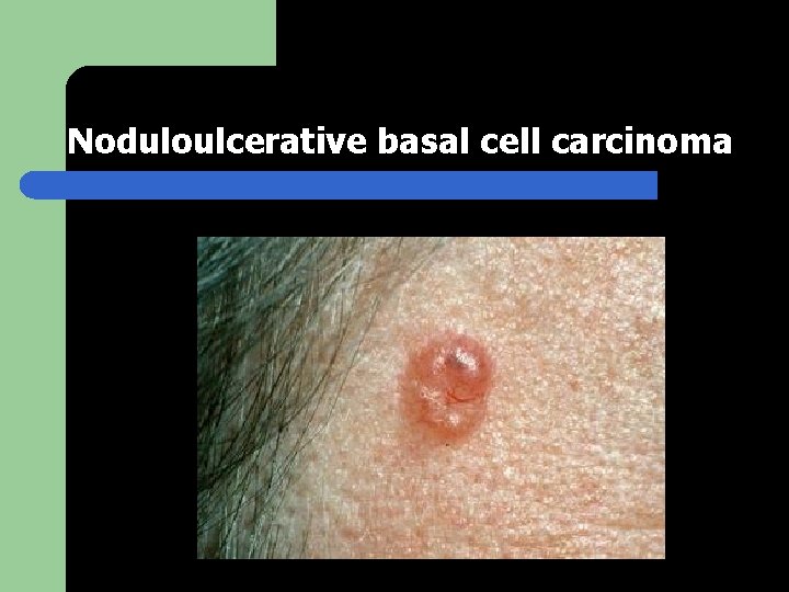 Noduloulcerative basal cell carcinoma 