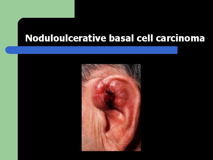 Noduloulcerative basal cell carcinoma 