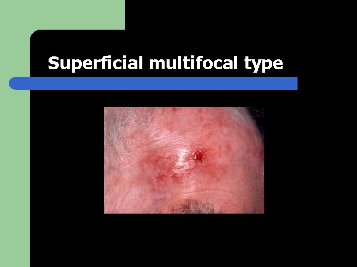 Superficial multifocal type 
