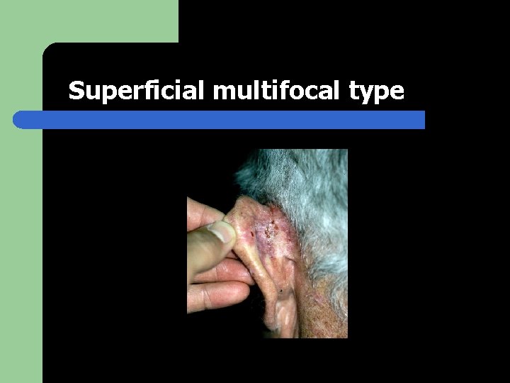 Superficial multifocal type 