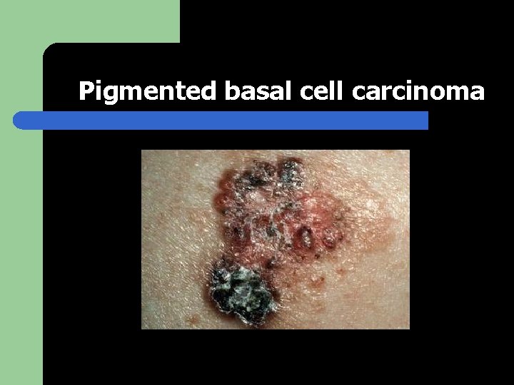 Pigmented basal cell carcinoma 