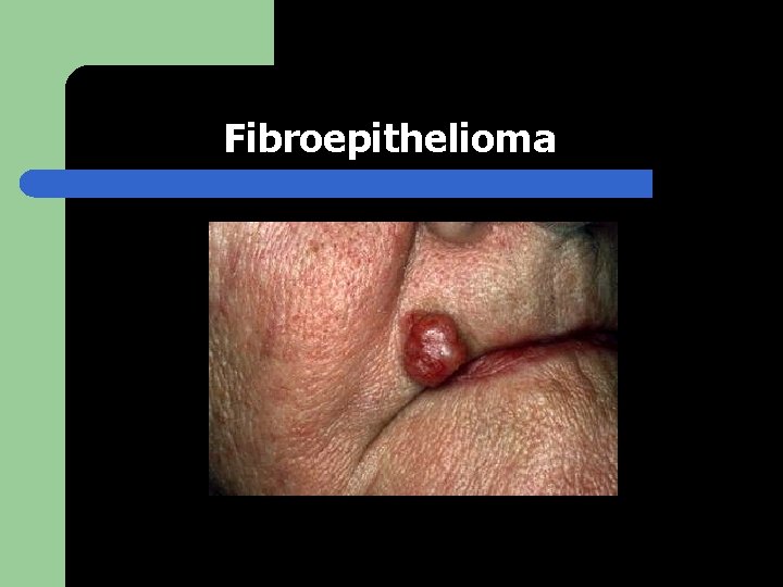 Fibroepithelioma 