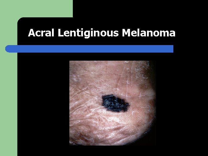 Acral Lentiginous Melanoma 