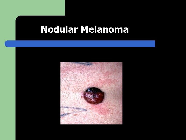 Nodular Melanoma 