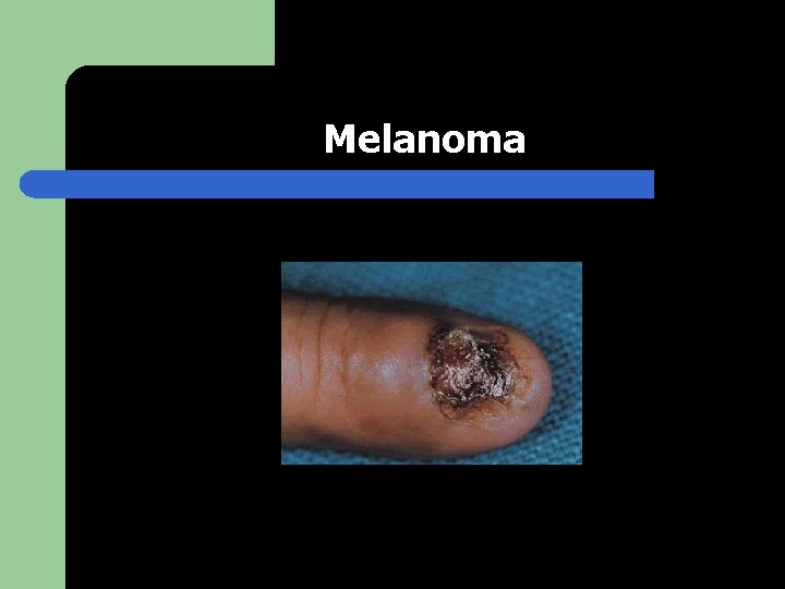 Melanoma 