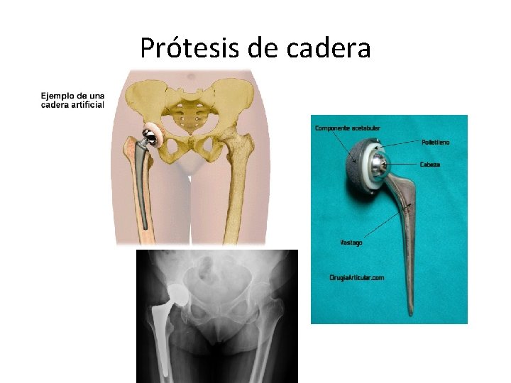 Prótesis de cadera 