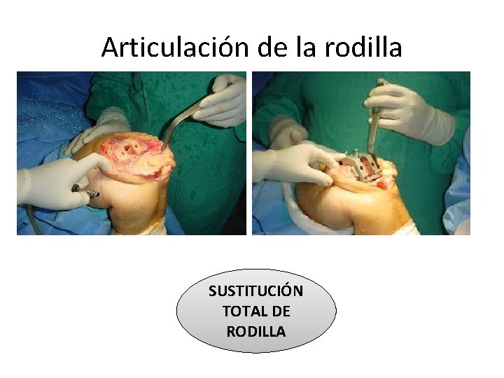 Articulación de la rodilla SUSTITUCIÓN TOTAL DE RODILLA 