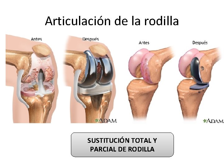 Articulación de la rodilla SUSTITUCIÓN TOTAL Y PARCIAL DE RODILLA 