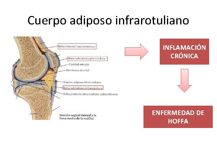 Cuerpo adiposo infrarotuliano INFLAMACIÓN CRÓNICA ENFERMEDAD DE HOFFA 