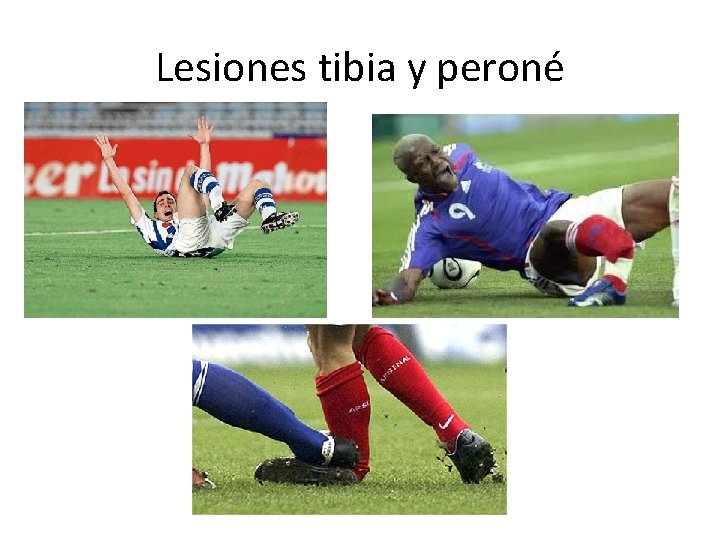 Lesiones tibia y peroné 