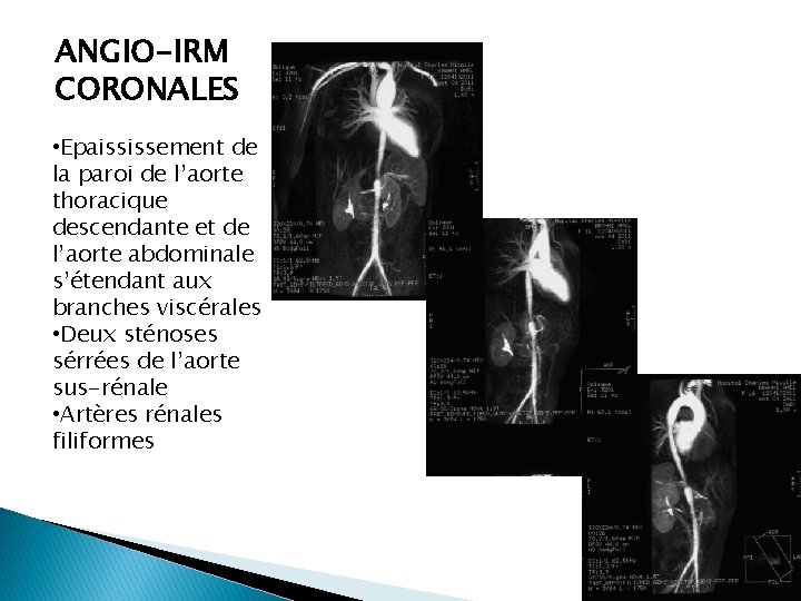 ANGIO-IRM CORONALES • Epaississement de la paroi de l’aorte thoracique descendante et de l’aorte