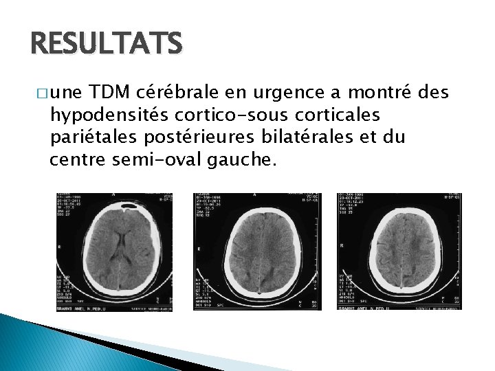 RESULTATS � une TDM cérébrale en urgence a montré des hypodensités cortico-sous corticales pariétales