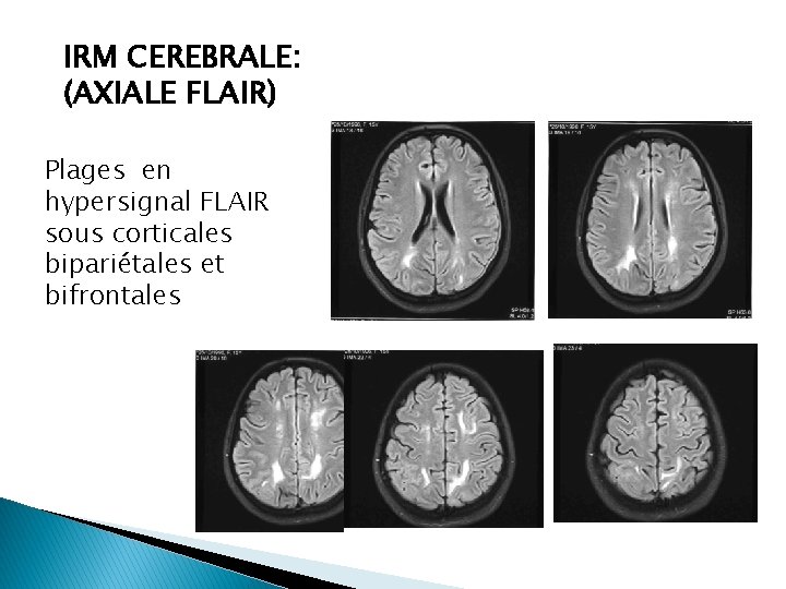 IRM CEREBRALE: (AXIALE FLAIR) Plages en hypersignal FLAIR sous corticales bipariétales et bifrontales 