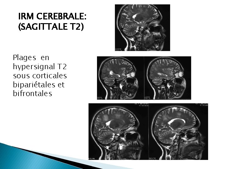 IRM CEREBRALE: (SAGITTALE T 2) Plages en hypersignal T 2 sous corticales bipariétales et