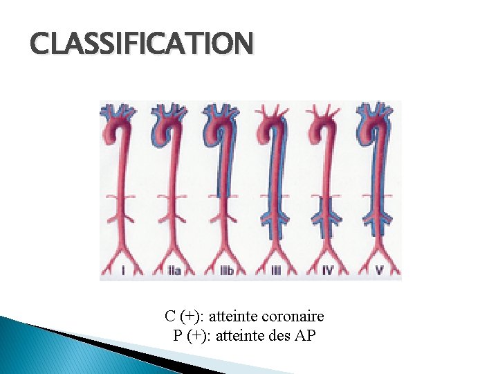 CLASSIFICATION C (+): atteinte coronaire P (+): atteinte des AP 