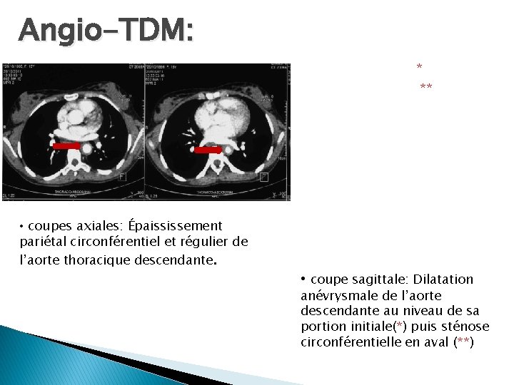 Angio-TDM: * ** • coupes axiales: Épaississement pariétal circonférentiel et régulier de l’aorte thoracique