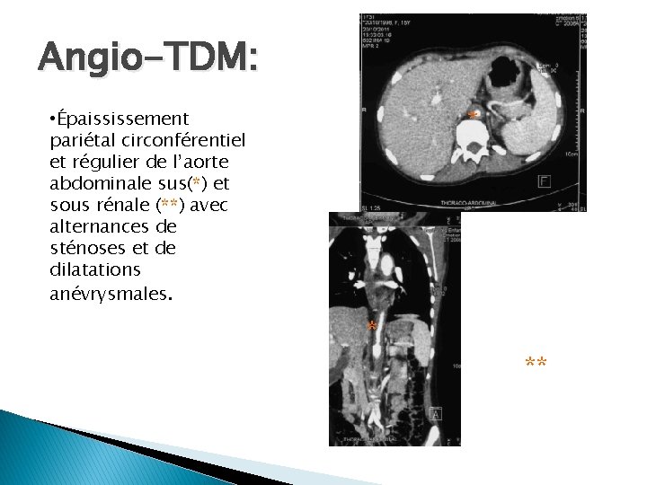 Angio-TDM: * • Épaississement pariétal circonférentiel et régulier de l’aorte abdominale sus(*) et sous