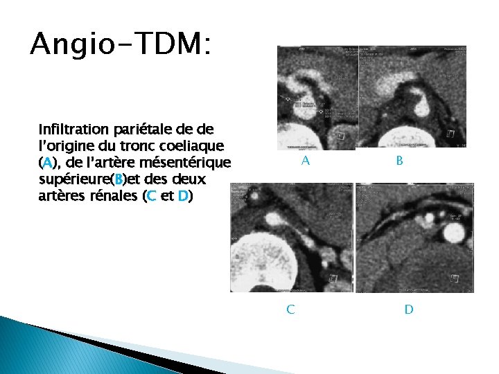 Angio-TDM: Infiltration pariétale de de l’origine du tronc coeliaque (A), de l’artère mésentérique supérieure(B)et