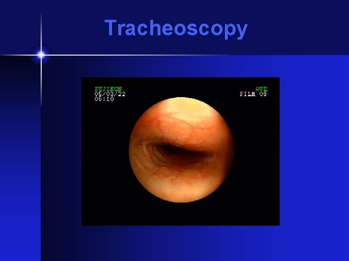 Tracheoscopy 