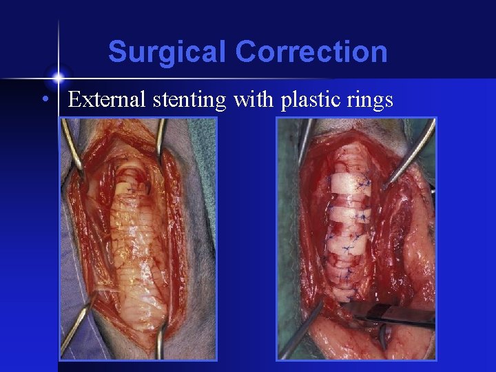 Surgical Correction • External stenting with plastic rings 