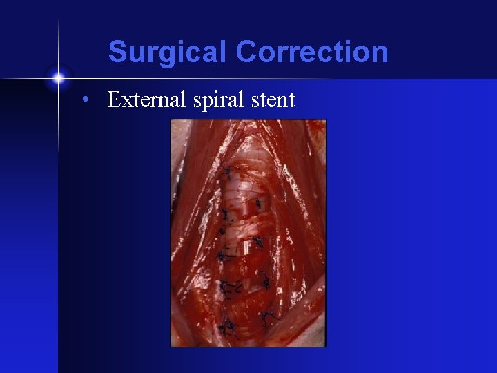 Surgical Correction • External spiral stent 