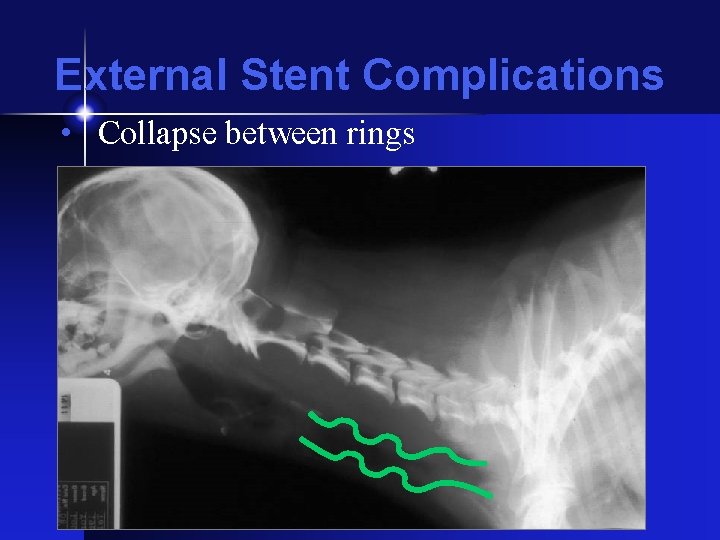 External Stent Complications • Collapse between rings 
