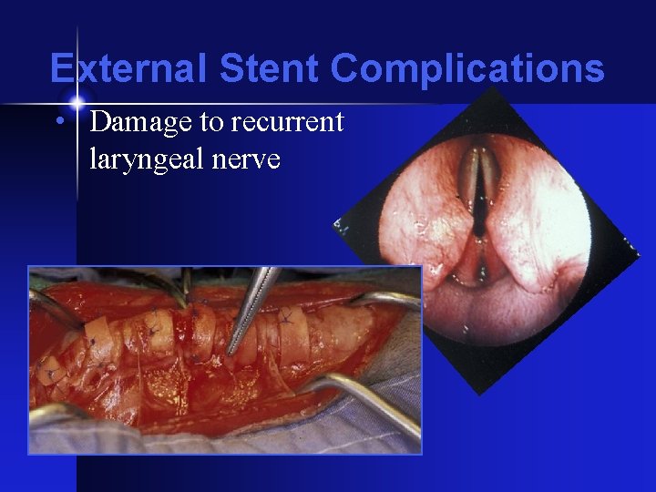 External Stent Complications • Damage to recurrent laryngeal nerve 