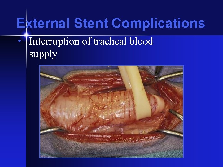 External Stent Complications • Interruption of tracheal blood supply 