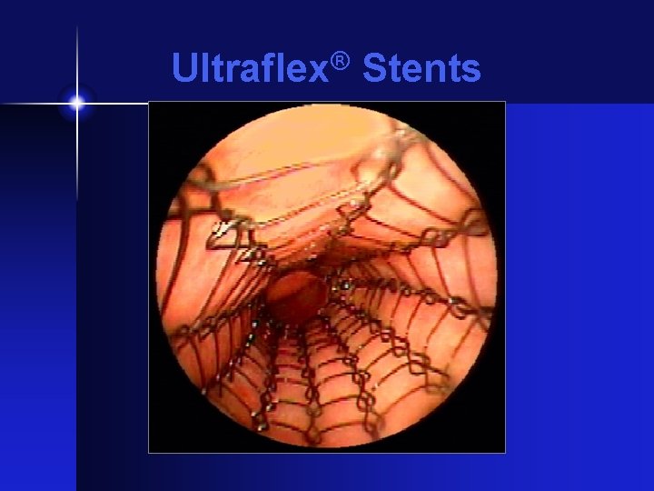 Ultraflex® Stents 