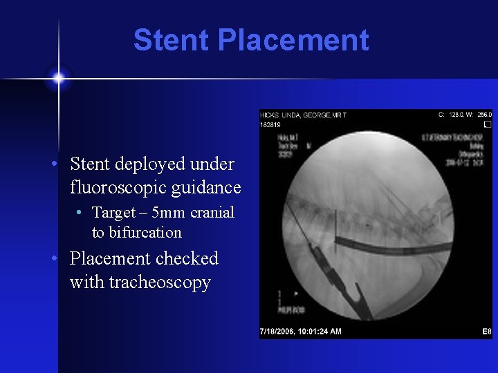 Stent Placement • Stent deployed under fluoroscopic guidance • Target – 5 mm cranial