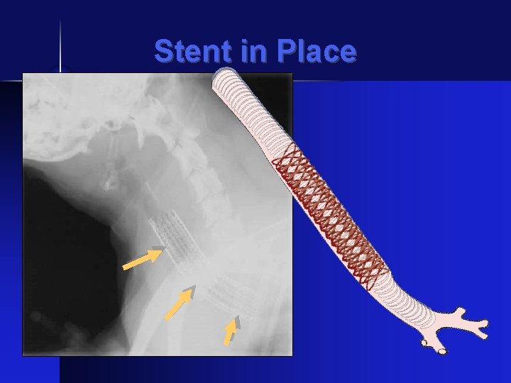 Stent in Place 