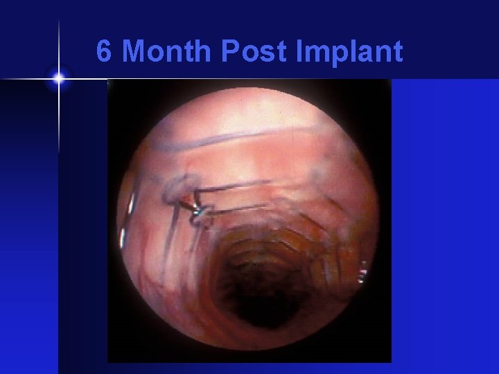 6 Month Post Implant 