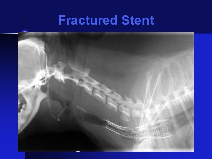 Fractured Stent 