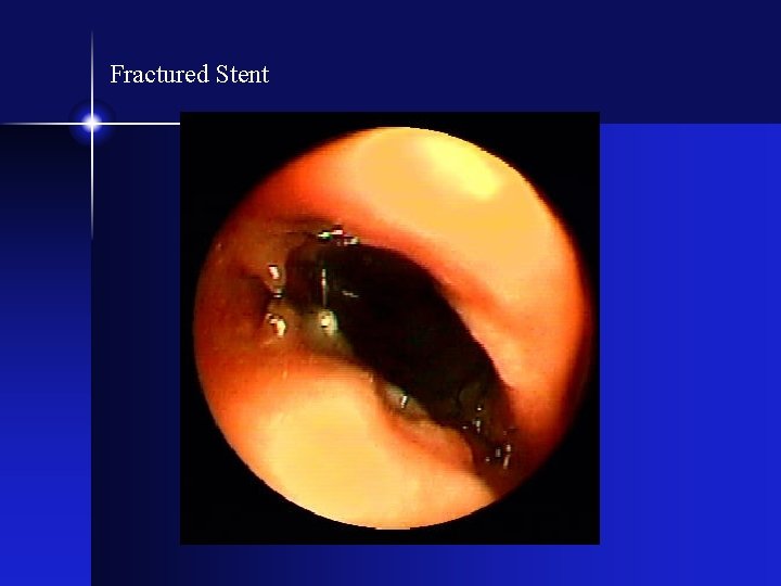 Fractured Stent 