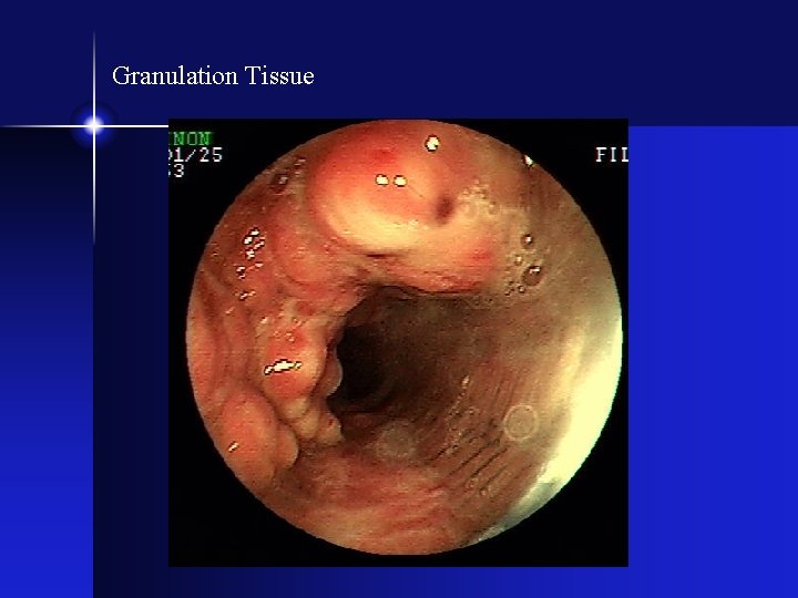 Granulation Tissue 