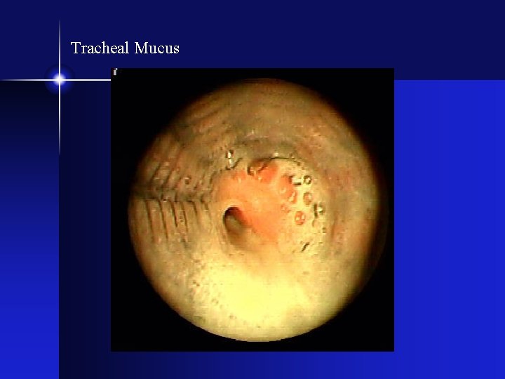 Tracheal Mucus 