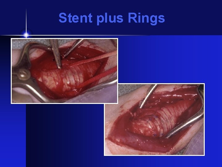 Stent plus Rings 