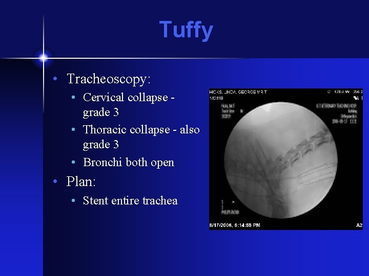 Tuffy • Tracheoscopy: • Cervical collapse grade 3 • Thoracic collapse - also grade