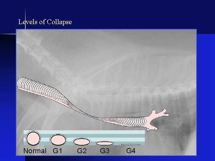 Levels of Collapse Normal G 1 G 2 G 3 G 4 