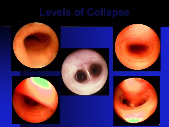 Levels of Collapse 