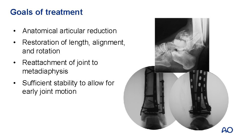 Goals of treatment • Anatomical articular reduction • Restoration of length, alignment, and rotation