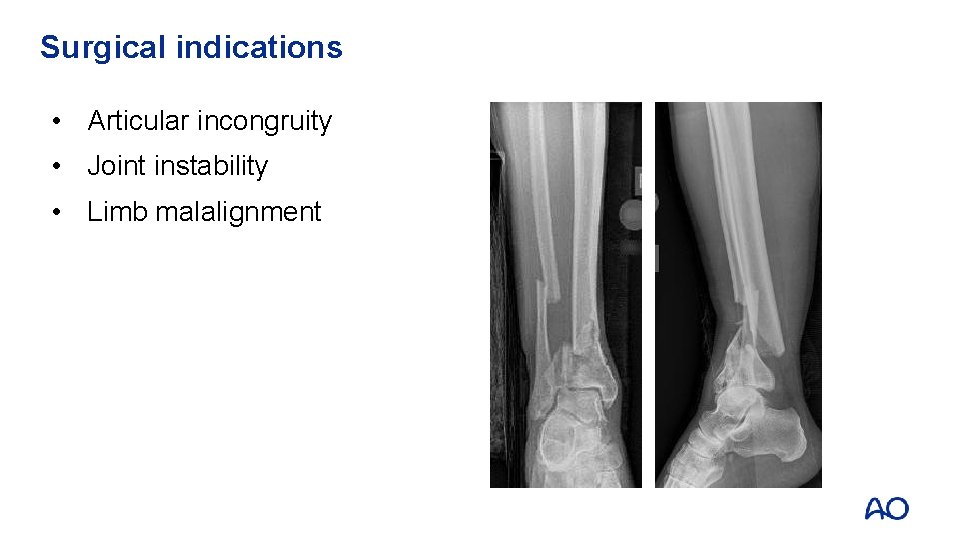 Surgical indications • Articular incongruity • Joint instability • Limb malalignment 
