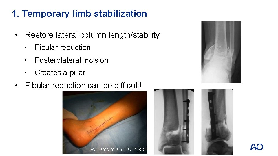 1. Temporary limb stabilization • Restore lateral column length/stability: • Fibular reduction • Posterolateral