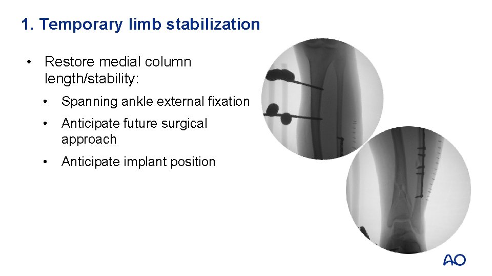 1. Temporary limb stabilization • Restore medial column length/stability: • Spanning ankle external fixation